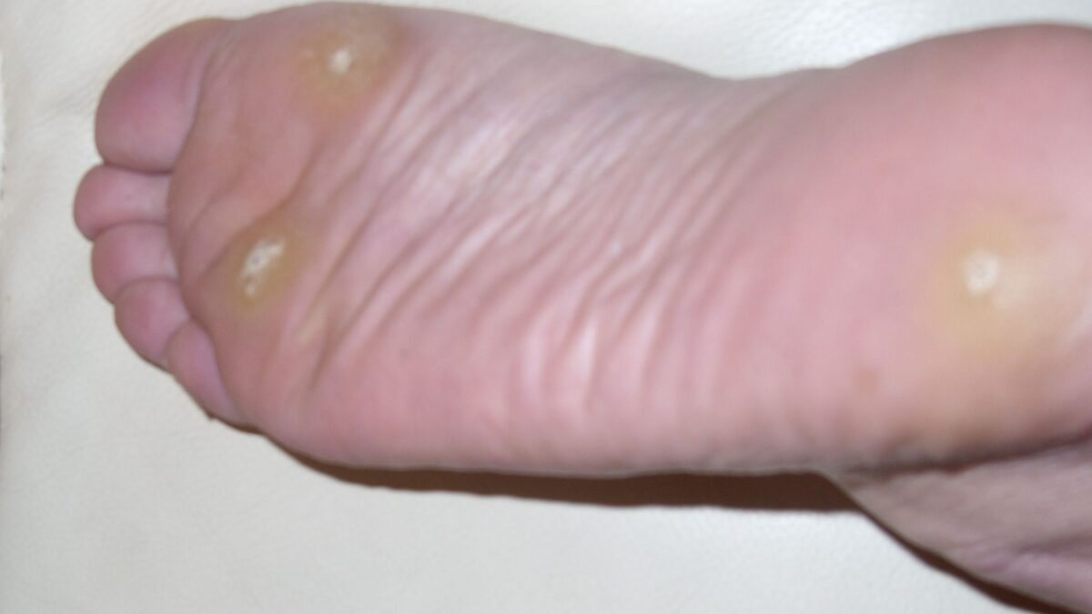 How do Warts Start to Develop?