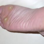 How do Warts Start to Develop?