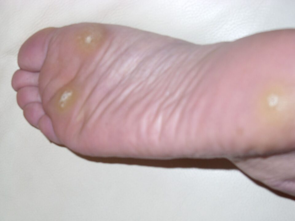 How do Warts Start to Develop?