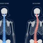 The Role of Early Intervention for Spine Fractures