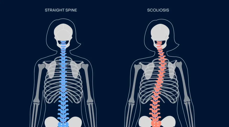 The Role of Early Intervention for Spine Fractures