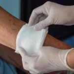 Effective Strategies for Managing Chronic Wounds