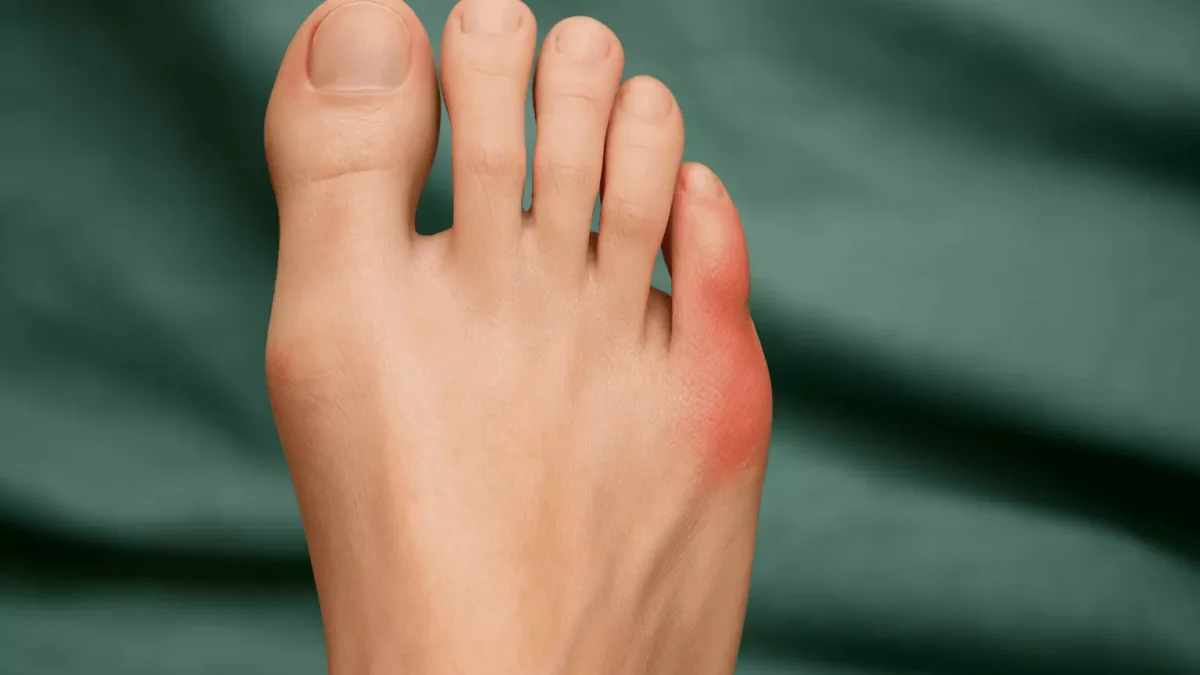 The Advantages of Early Intervention for Bunions