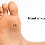 The Basics of Treating Plantar Warts