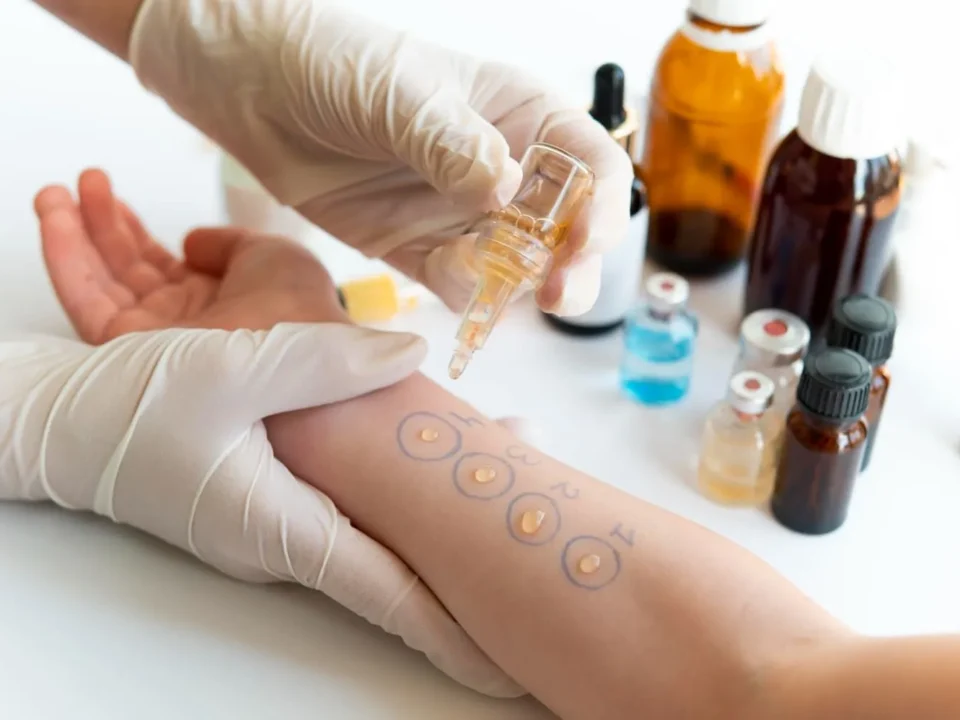The Role of Allergy Testing in Personalized Treatment Plans