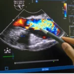 Understanding the Procedure and Benefits of Echocardiograms