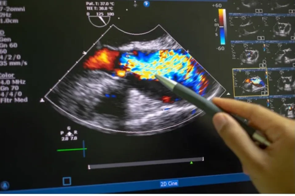 Understanding the Procedure and Benefits of Echocardiograms