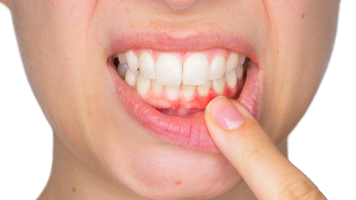 What to Expect After Oral Surgery from Gum Disease