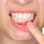 What to Expect After Oral Surgery from Gum Disease