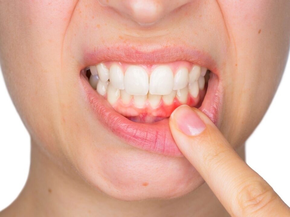 What to Expect After Oral Surgery from Gum Disease