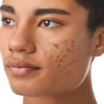 Exploring Common Dermatology Conditions