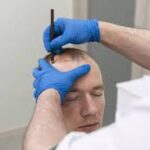 Exploring Non-surgical Alternatives to Hair Transplants