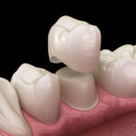 FAQs About Dental Crowns