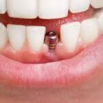How Dental Implants Can Improve Your Quality of Life