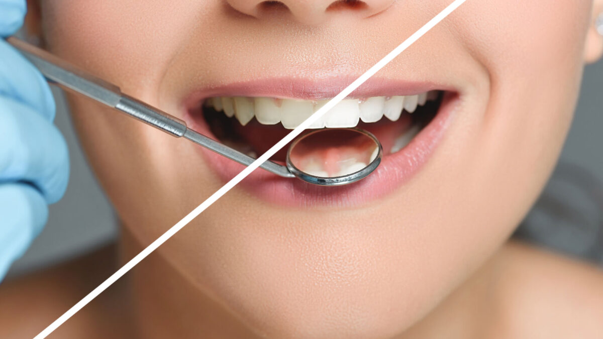 How a Cosmetic Dentist Can Help with Tooth Discoloration