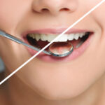 How a Cosmetic Dentist Can Help with Tooth Discoloration
