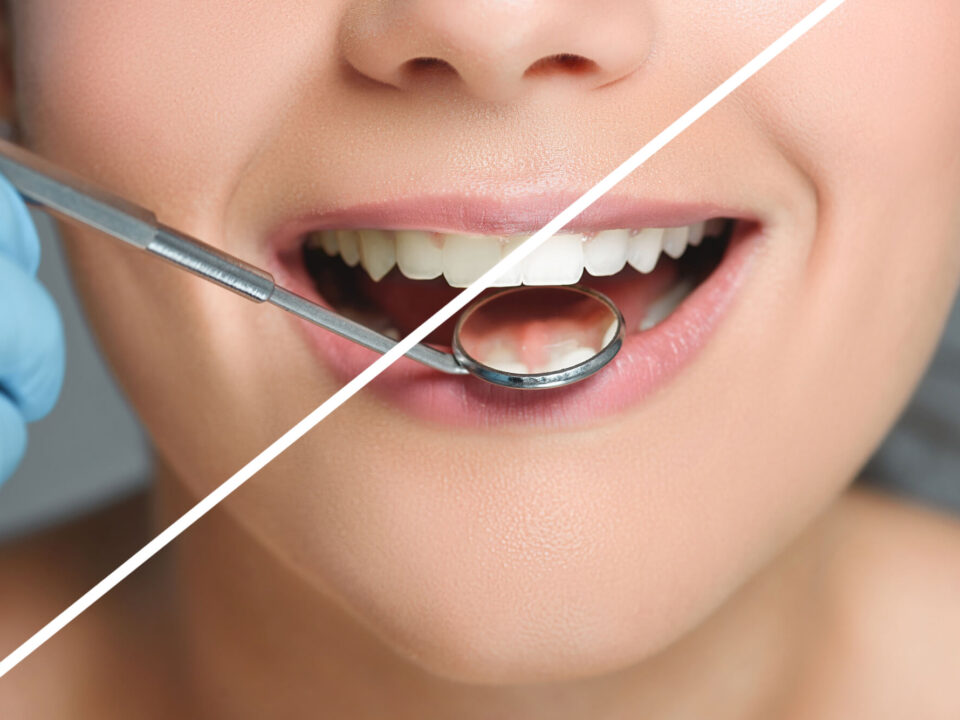 How a Cosmetic Dentist Can Help with Tooth Discoloration