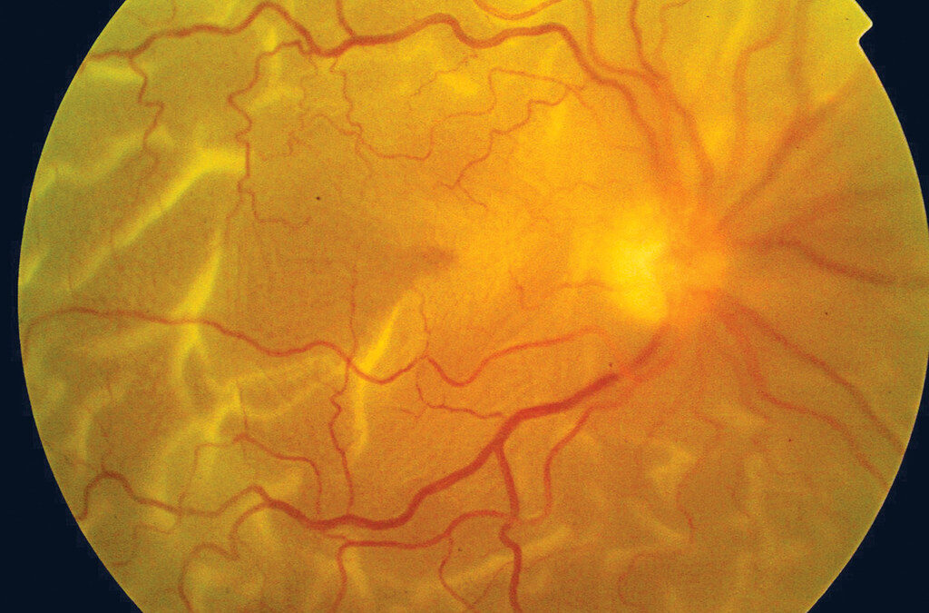Navigating the Effects of Retinal Detachment