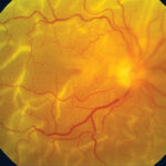Navigating the Effects of Retinal Detachment
