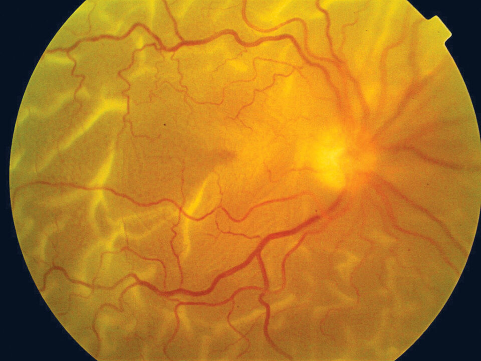 Navigating the Effects of Retinal Detachment