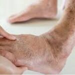 Recognizing the Symptoms of Chronic Vascular Disease
