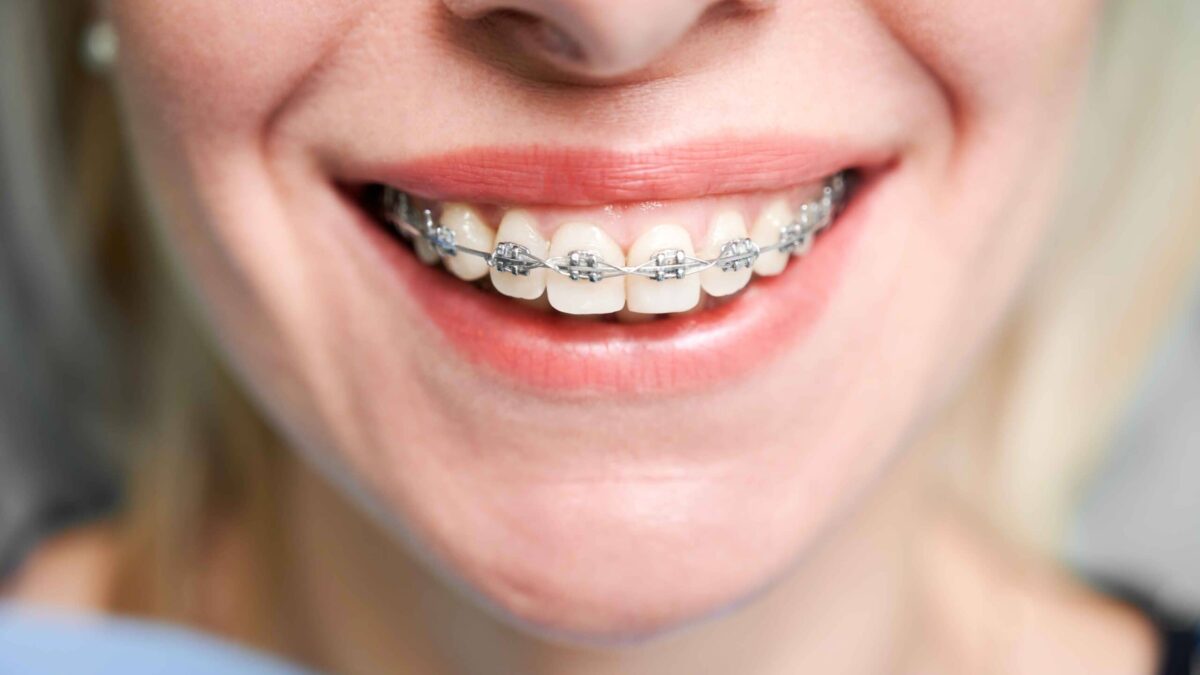 Tips for Adjusting to New Braces