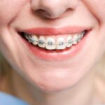 Tips for Adjusting to New Braces