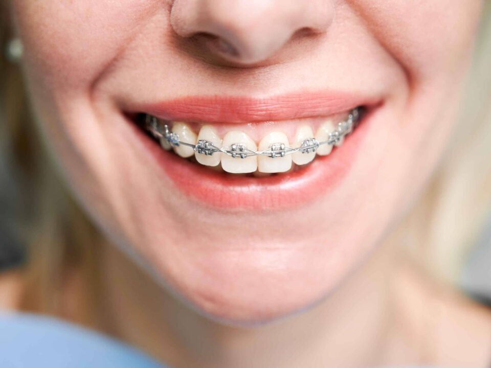 Tips for Adjusting to New Braces