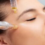 Using Morpheus-8 for Skin Rejuvenation
