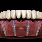 Advancing Dental Implants Through All-In-X Technique Innovations