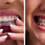 Benefits of Choosing Invisalign for Your Orthodontic Treatment