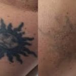 Comparing Laser Tattoo Removal to Traditional Methods
