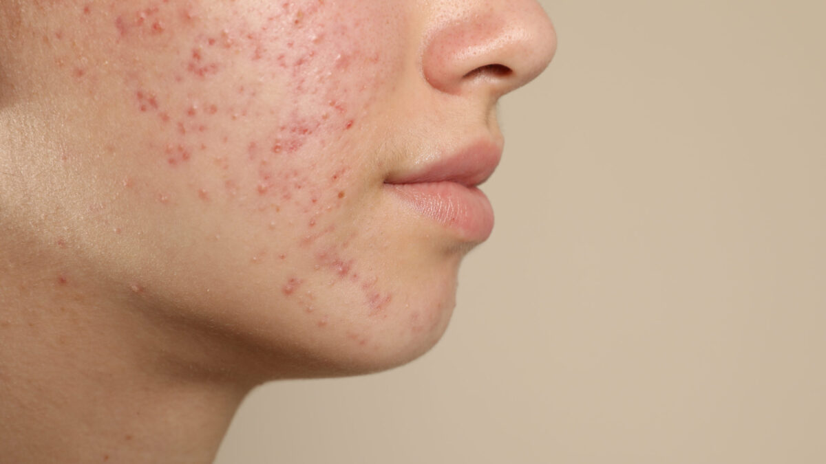 Exploring the Benefits of Dermatological Treatments for Acne