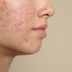 Exploring the Benefits of Dermatological Treatments for Acne
