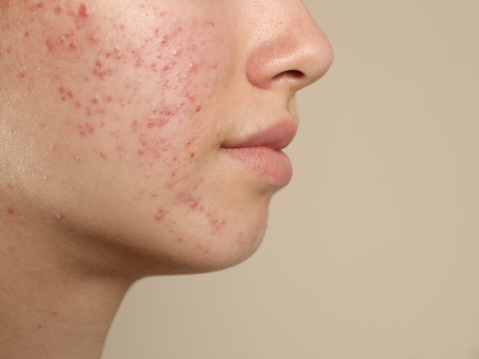 Exploring the Benefits of Dermatological Treatments for Acne