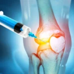 Exploring the Benefits of Knee Replacement Surgery