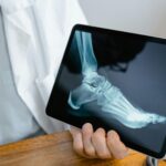 Frequently Asked Questions About Ankle Replacement