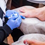 Home Remedies vs. Professional Care for Treating Ingrown Toenails