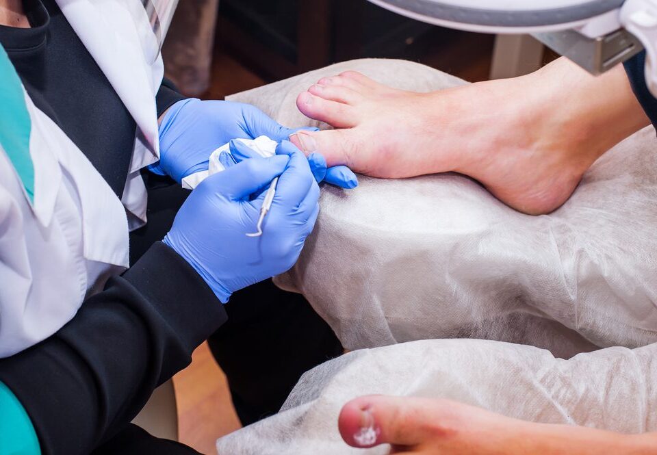 Home Remedies vs. Professional Care for Treating Ingrown Toenails