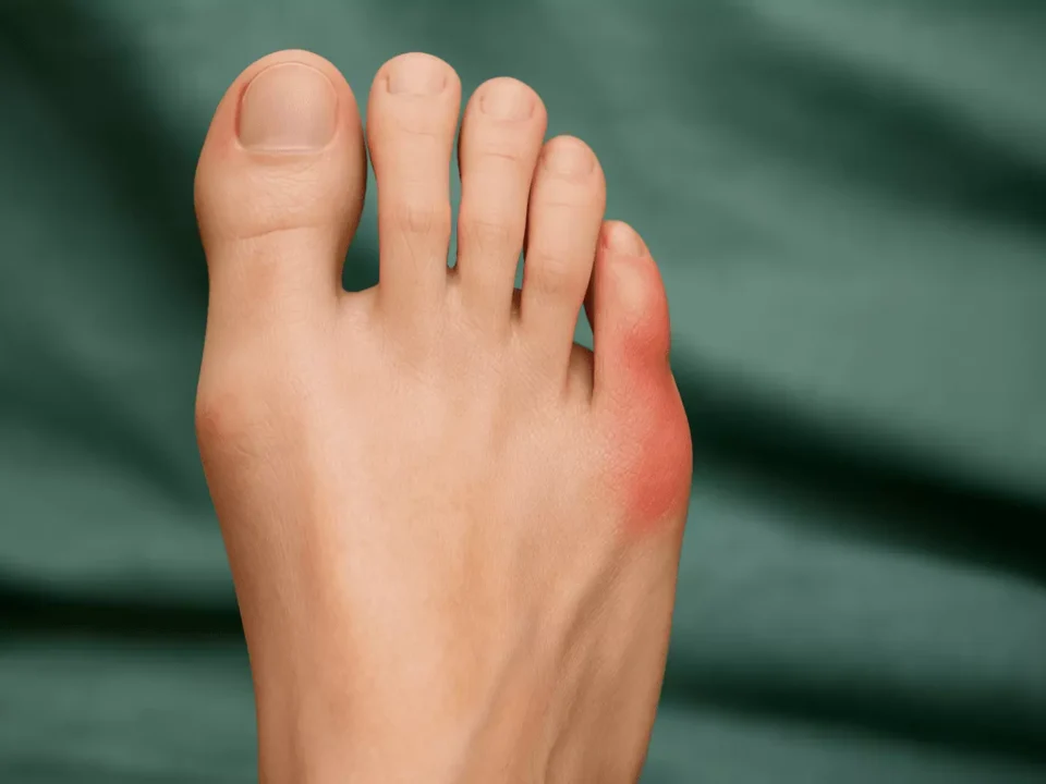 How To Manage Bunions at Home