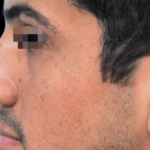 How to Manage Your Symptoms Before and After Balloon Sinuplasty