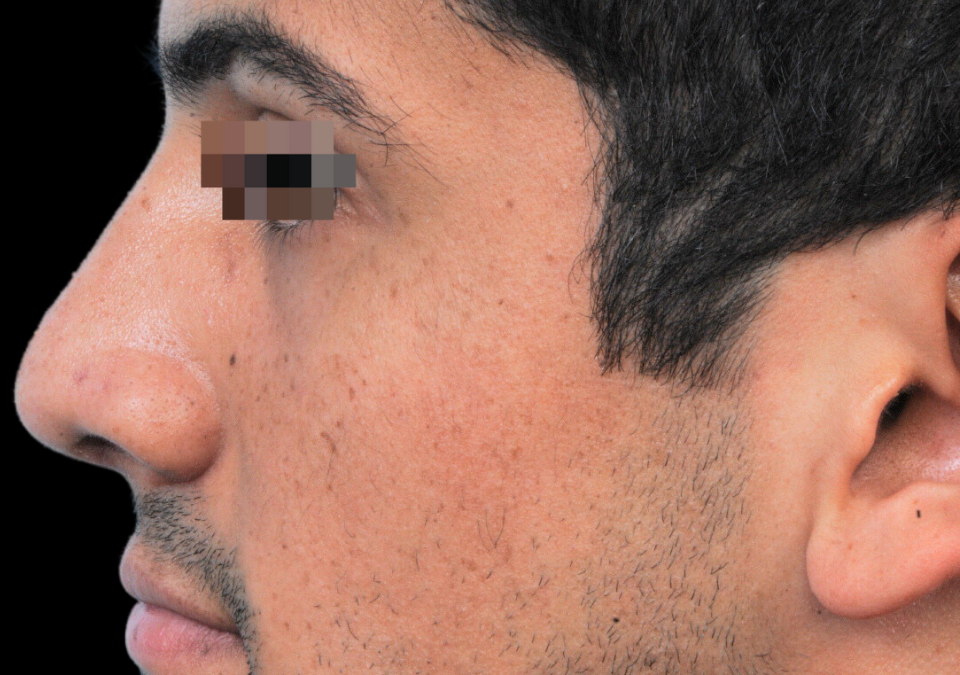 How to Manage Your Symptoms Before and After Balloon Sinuplasty