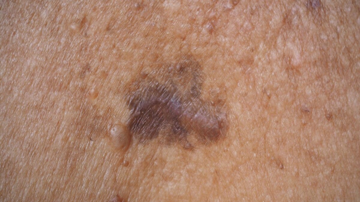 Melanoma vs. Other Skin Cancers