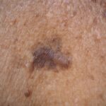 Melanoma vs. Other Skin Cancers