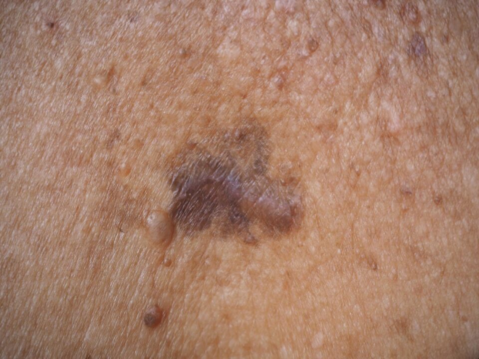 Melanoma vs. Other Skin Cancers