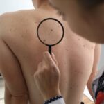 Recognizing the Early Signs of Skin Cancer