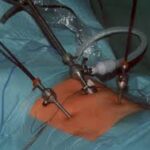 Surgical Techniques Used by Hernia Surgeons
