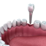 The Benefits of Choosing Dental Implants Over Other Solutions