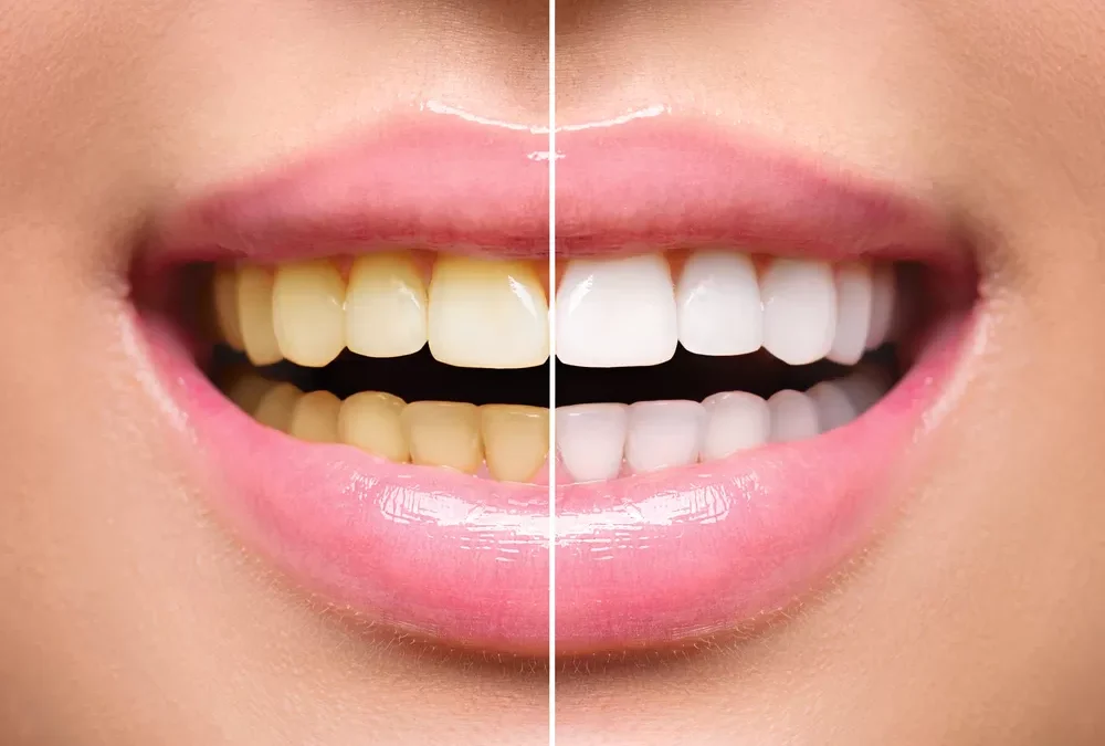 The Benefits of Teeth Whitening in Cosmetic Dentistry