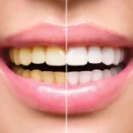 The Benefits of Teeth Whitening in Cosmetic Dentistry